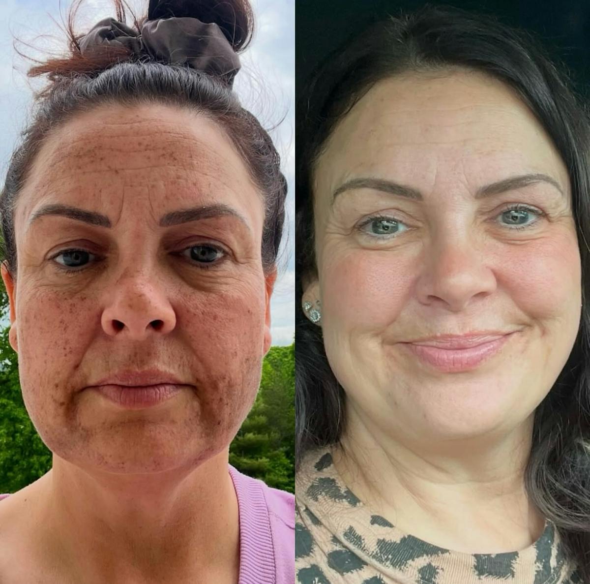 Lasers & Light Before & After Gallery - Patient 197704 - Image 1