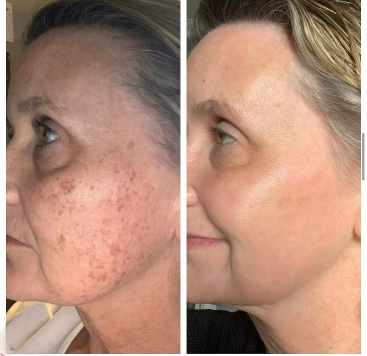 Lasers & Light Before & After Gallery - Patient 241954 - Image 1