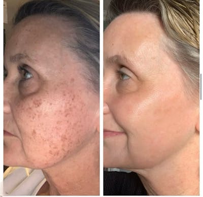 Lasers & Light Before & After Gallery - Patient 241954 - Image 1