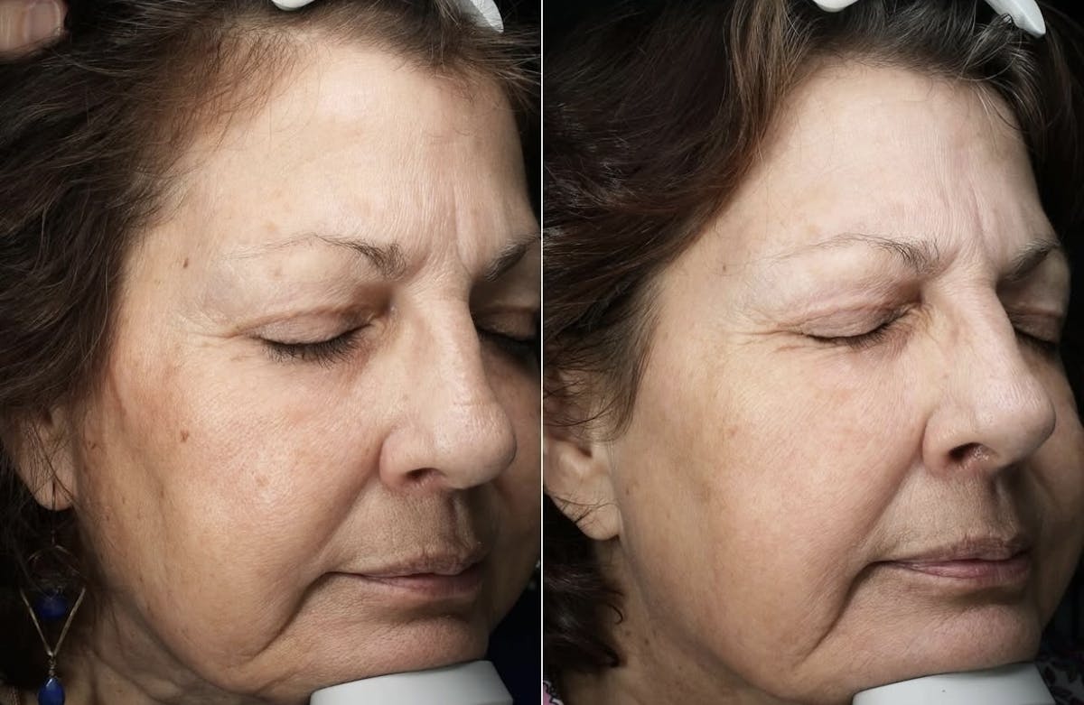 Lasers & Light Before & After Gallery - Patient 126601 - Image 1
