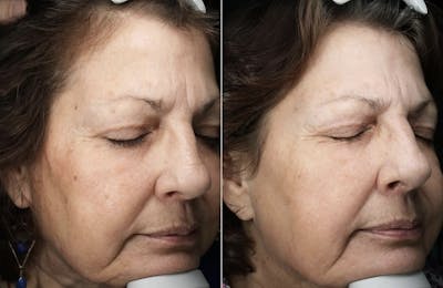 Lasers & Light Before & After Gallery - Patient 126601 - Image 1