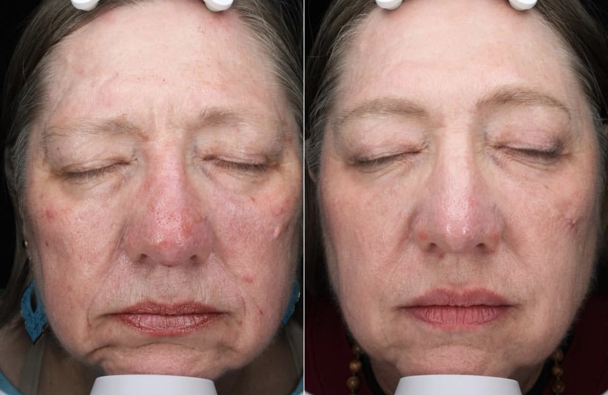 Lasers & Light Before & After Gallery - Patient 392715 - Image 1