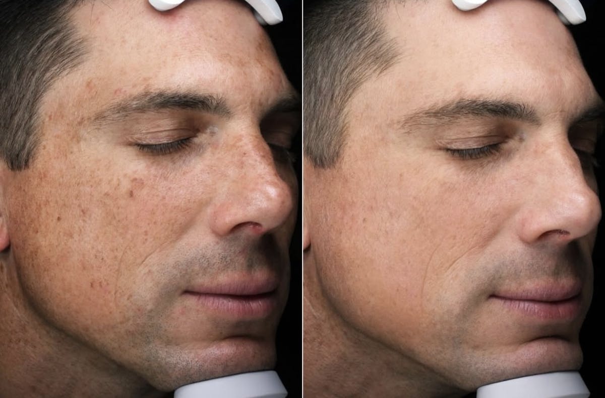 Lasers & Light Before & After Gallery - Patient 259272 - Image 1