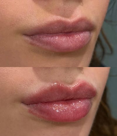 Facial Fillers Before & After Gallery - Patient 222504 - Image 1