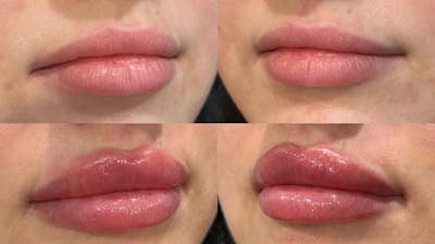 Facial Fillers Before & After Gallery - Patient 226813 - Image 1