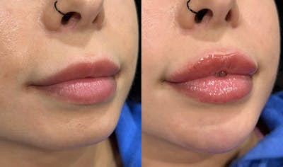 Facial Fillers Before & After Gallery - Patient 236100 - Image 1