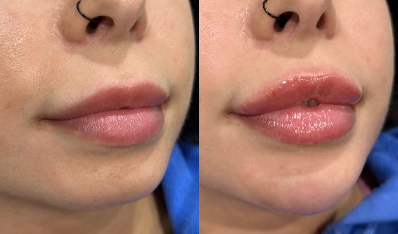 Facial Fillers Before & After Gallery - Patient 236100 - Image 1