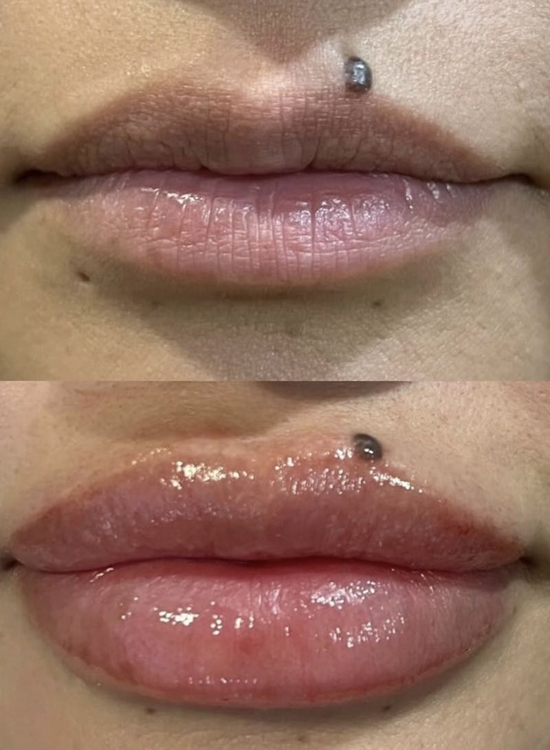 Facial Fillers Before & After Gallery - Patient 313978 - Image 1
