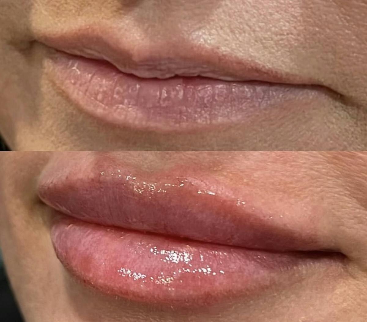 Facial Fillers Before & After Gallery - Patient 210133 - Image 1