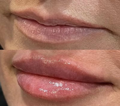 Facial Fillers Before & After Gallery - Patient 210133 - Image 1