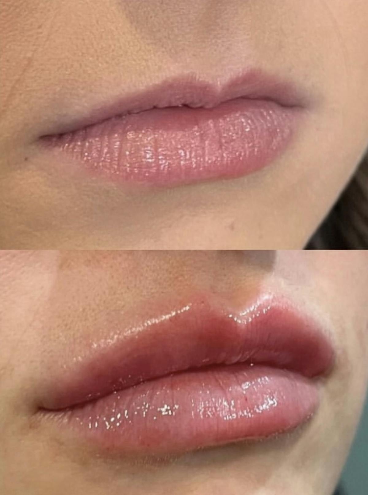 Facial Fillers Before & After Gallery - Patient 413851 - Image 1