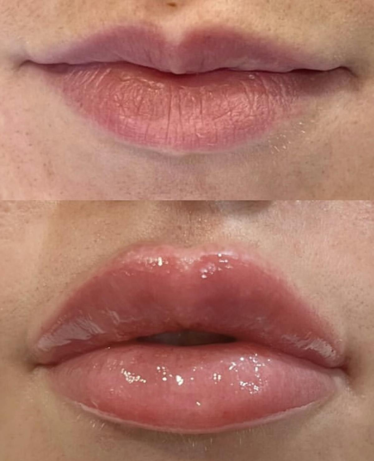 Facial Fillers Before & After Gallery - Patient 301562 - Image 1