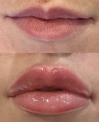 Facial Fillers Before & After Gallery - Patient 301562 - Image 1