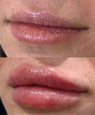 Facial Fillers Before & After Gallery - Patient 401481 - Image 1