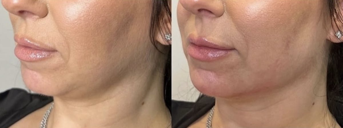 Facial Fillers Before & After Gallery - Patient 330614 - Image 1