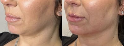 Facial Fillers Before & After Gallery - Patient 330614 - Image 1