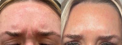 Neuromodulator Injections Before & After Gallery - Patient 553197 - Image 1