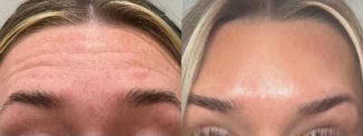 Neuromodulator Injections Before & After Gallery - Patient 553197 - Image 2