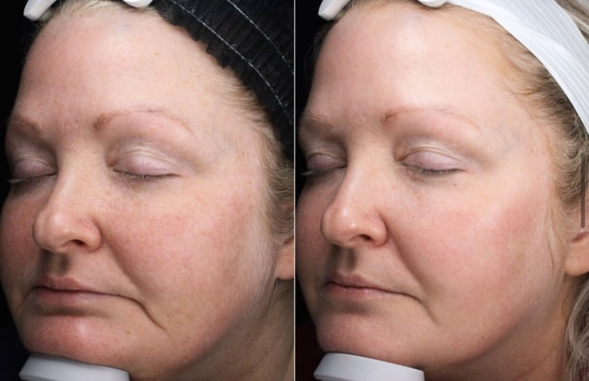 Lasers & Light Before & After Gallery - Patient 732268 - Image 1