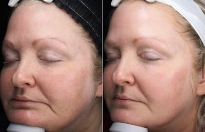 Lasers & Light Before & After Gallery - Patient 732268 - Image 1