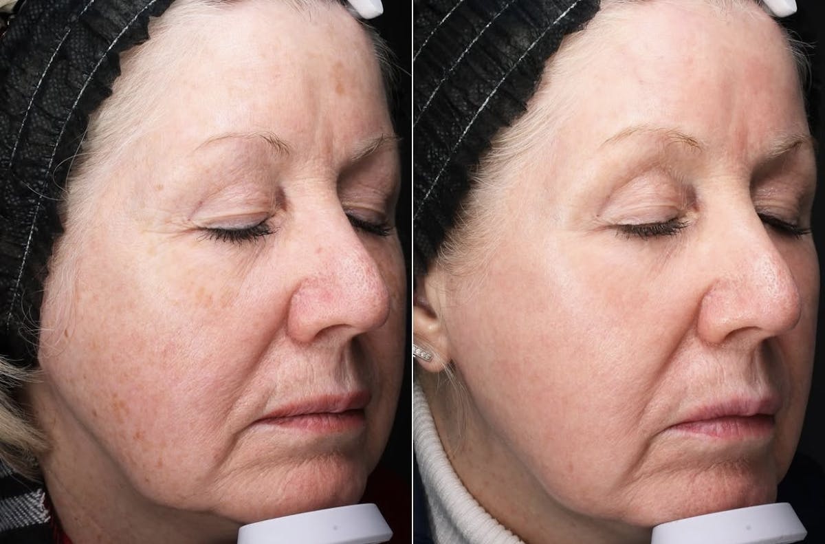 Lasers & Light Before & After Gallery - Patient 345438 - Image 1