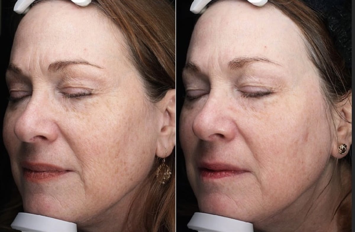 Lasers & Light Before & After Gallery - Patient 381709 - Image 1