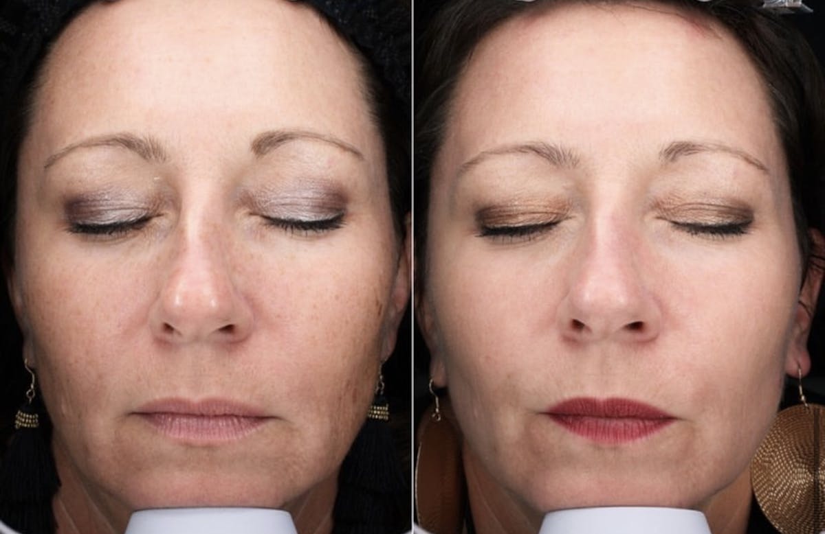 Lasers & Light Before & After Gallery - Patient 188798 - Image 1