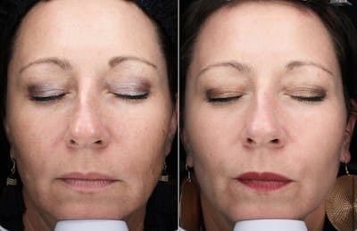 Lasers & Light Before & After Gallery - Patient 188798 - Image 1