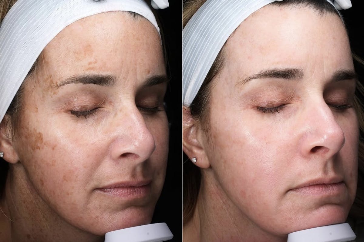 Lasers & Light Before & After Gallery - Patient 409989 - Image 2