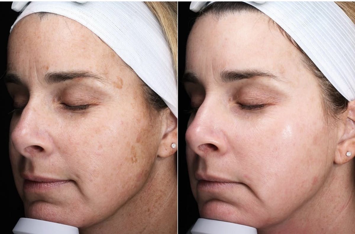 Lasers & Light Before & After Gallery - Patient 409989 - Image 1