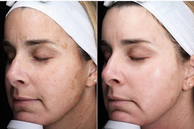 Lasers & Light Before & After Gallery - Patient 409989 - Image 1