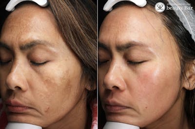 Skincare Before & After Gallery - Patient 322090 - Image 1