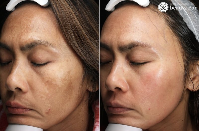 Skincare Before & After Gallery - Patient 322090 - Image 1