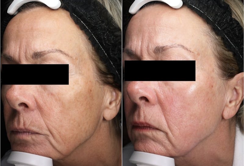 SylfirmX Before & After Gallery - Patient 263071 - Image 3