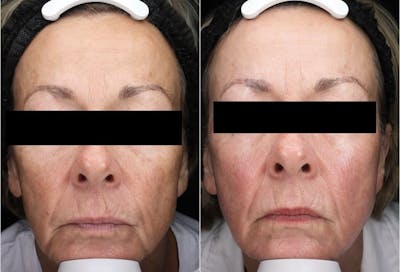 SylfirmX Before & After Gallery - Patient 263071 - Image 1