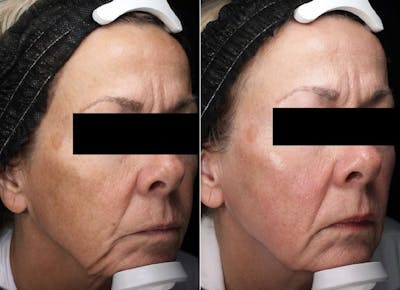 SylfirmX Before & After Gallery - Patient 263071 - Image 2