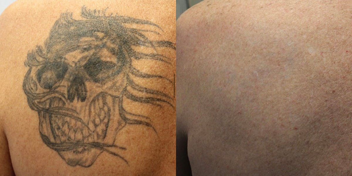 Lasers & Light Before & After Gallery - Patient 516497 - Image 1