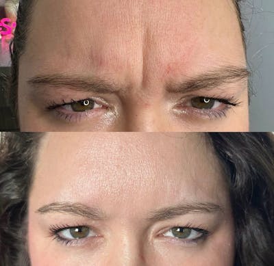 Neuromodulator Injections Before & After Gallery - Patient 184504 - Image 1
