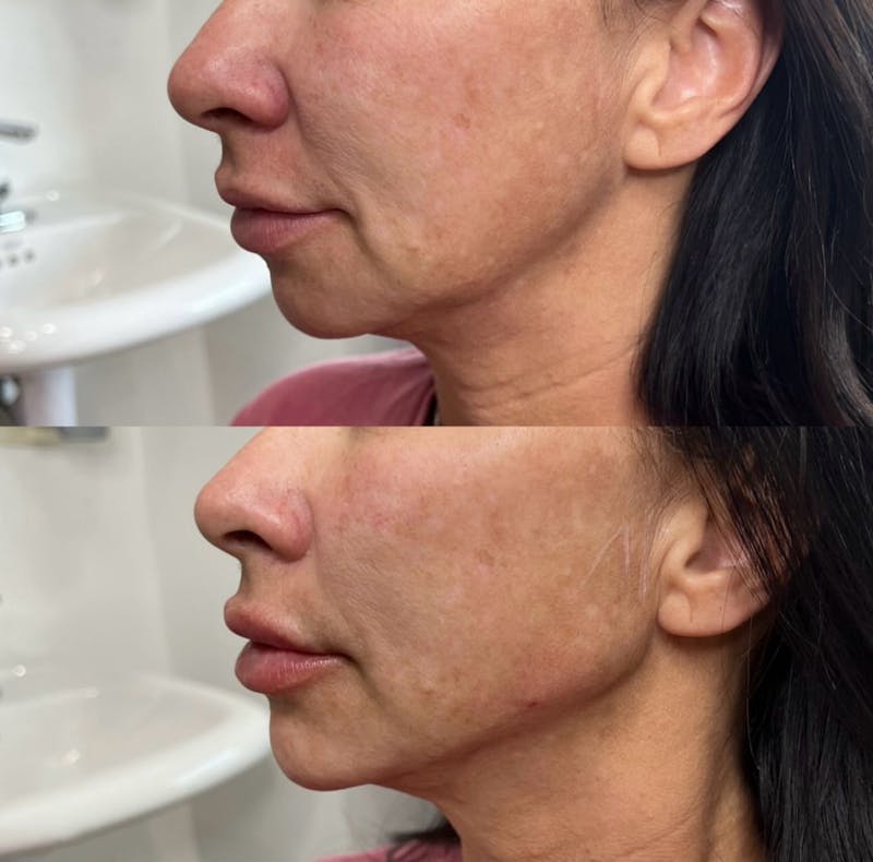 Facial Fillers Before & After Gallery - Patient 396179 - Image 1
