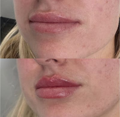 Facial Fillers Before & After Gallery - Patient 186681 - Image 1