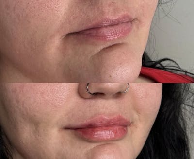 Facial Fillers Before & After Gallery - Patient 245078 - Image 1