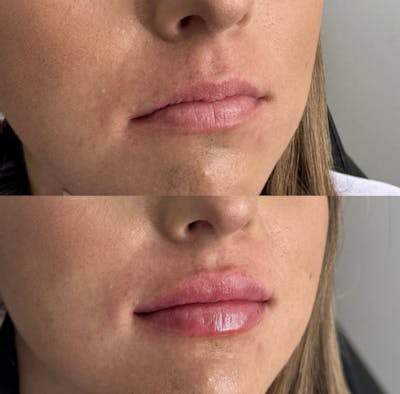 Facial Fillers Before & After Gallery - Patient 219592 - Image 1