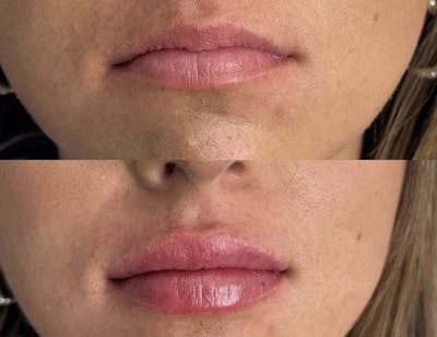 Facial Fillers Before & After Gallery - Patient 103287 - Image 1