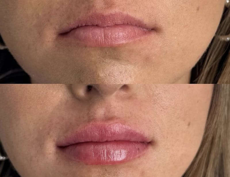 Facial Fillers Before & After Gallery - Patient 103287 - Image 1