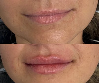 Facial Fillers Before & After Gallery - Patient 361505 - Image 1