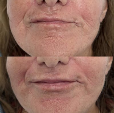 Facial Fillers Before & After Gallery - Patient 360341 - Image 1