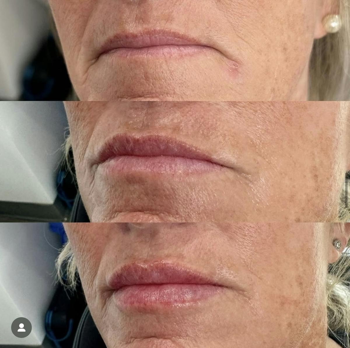Facial Fillers Before & After Gallery - Patient 142609 - Image 1