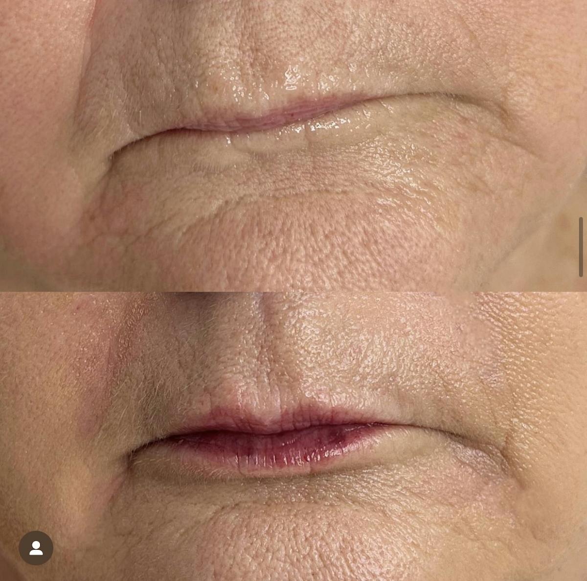 Facial Fillers Before & After Gallery - Patient 357537 - Image 1