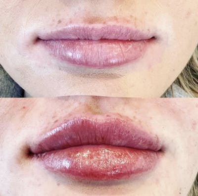 Facial Fillers Before & After Gallery - Patient 258215 - Image 1