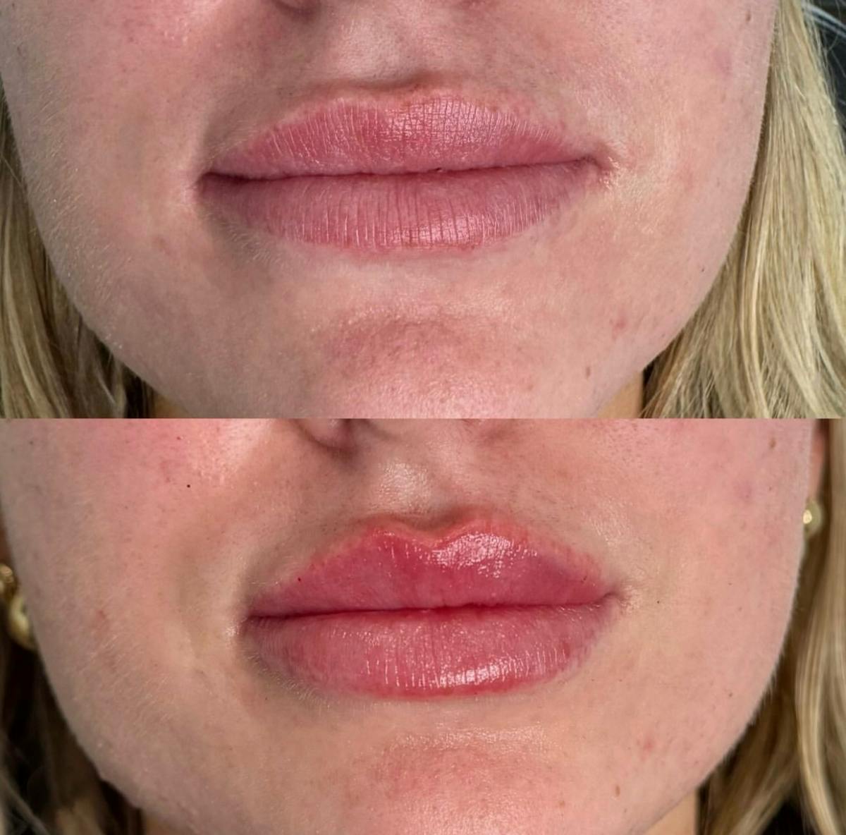 Facial Fillers Before & After Gallery - Patient 468194 - Image 1